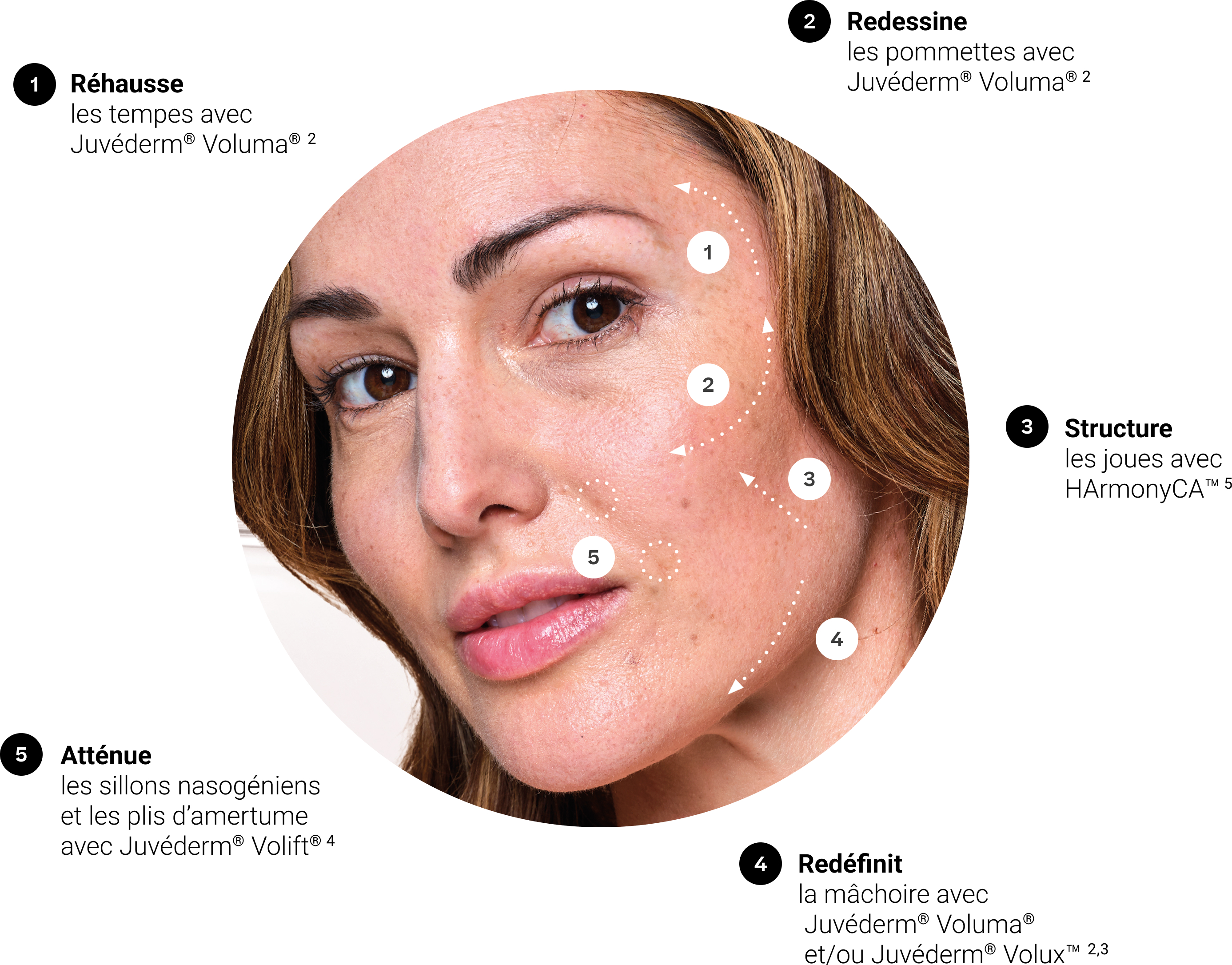 Photo d'un visage illustrant les zones traitées lors d'un protocole esthétique Lift Up avec injections d'acide hyaluronique.
