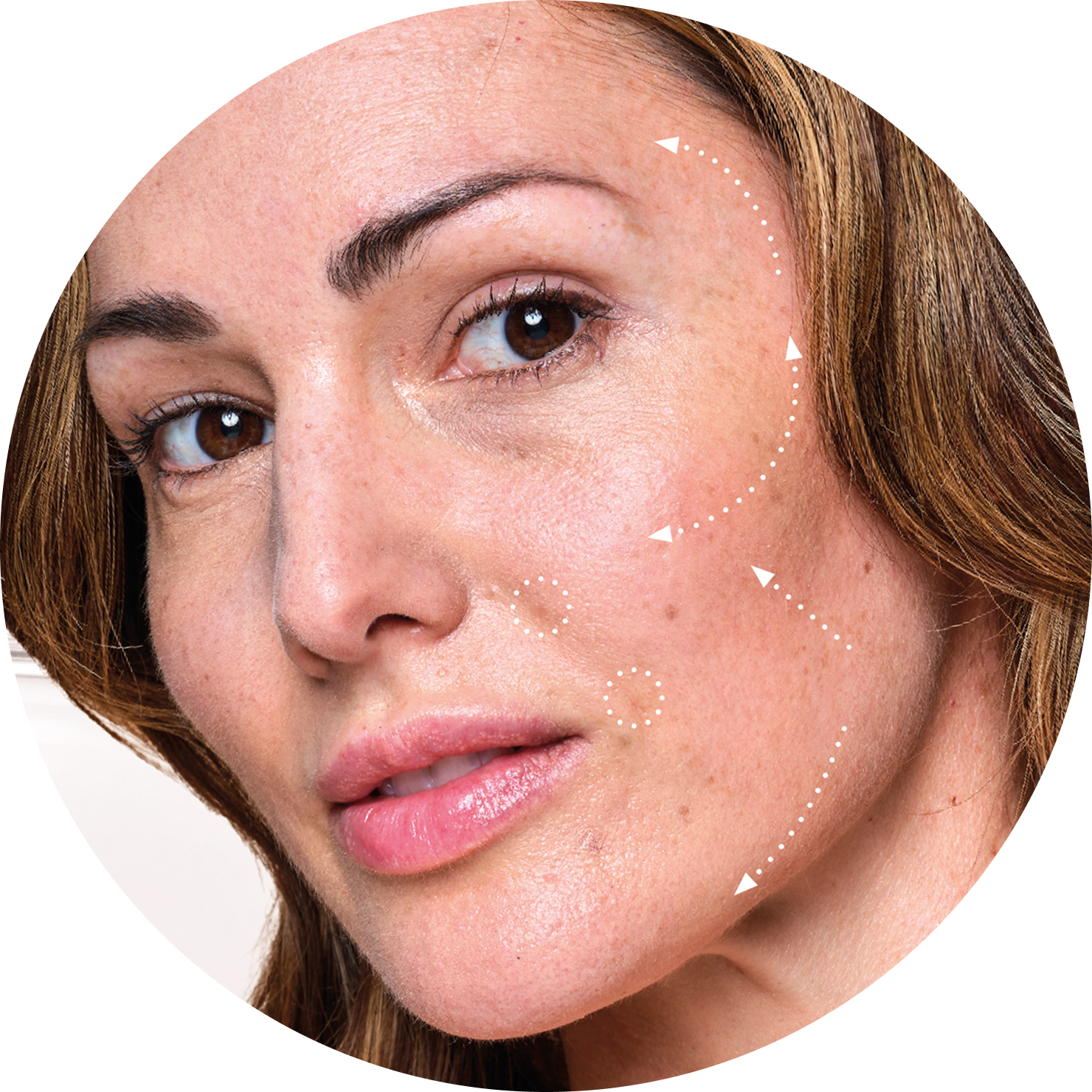 Photo d'un visage illustrant les zones traitées lors d'un protocole esthétique Lift Up avec injections d'acide hyaluronique.